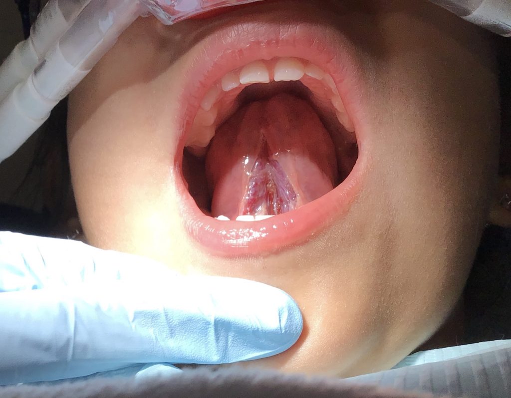 After frenulum and breve before Penis Frenulectomy.