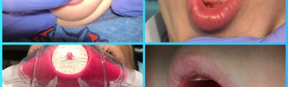 Tongue Tie Release Success Story at Stonebrook Pediatric Dentistry