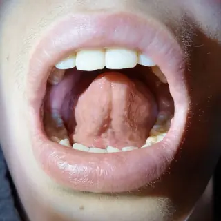 The same child's tongue lifted to the roof of the mouth one week after the release