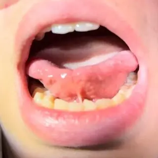 Child's tongue pulled into a heart shape by a tongue tie before the release