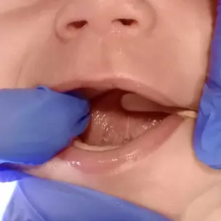 The same infant's tongue lifting freely one month after the release